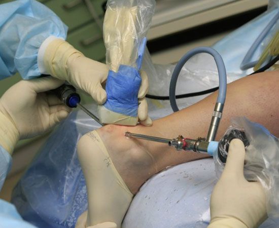 Ankle Arthroscopy Specialist Meerut