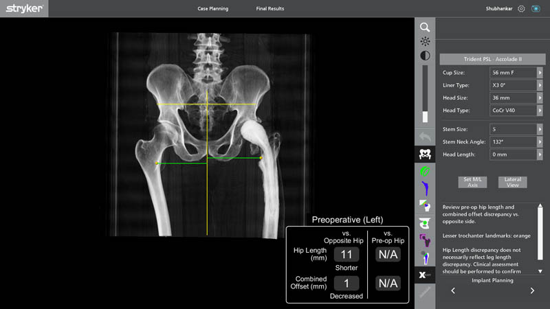 Robotic implant planning for revision hip replacement surgery