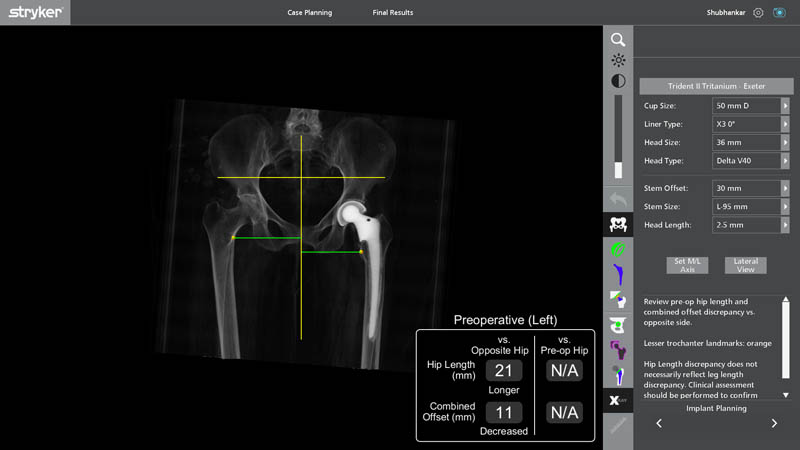 Robotic implant planning for revision hip replacement surgery