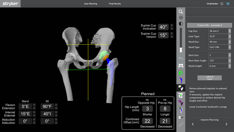 Robotic implant planning for revision hip replacement surgery