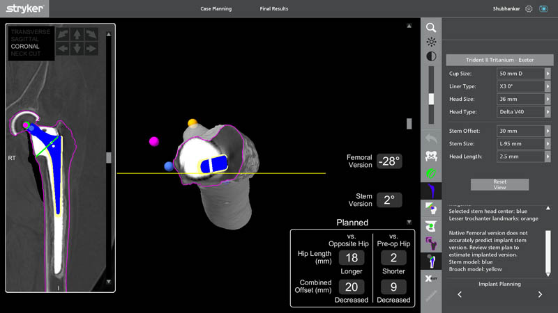 Robotic implant planning for revision hip replacement surgery