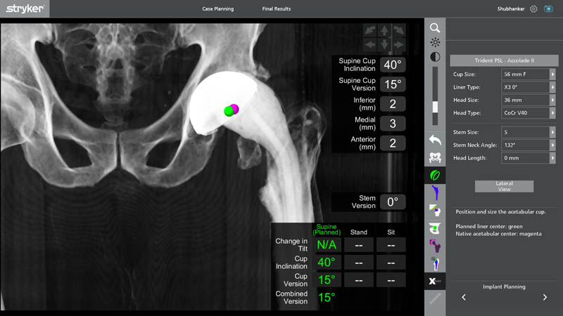 Robotic implant planning for revision hip replacement surgery