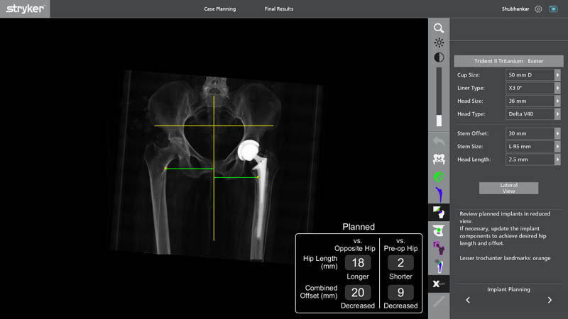 Robotic implant planning for revision hip replacement surgery