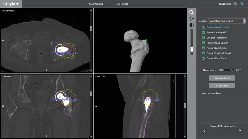 Femoral CT landmarks used in segmentation for robotic revision hip replacement