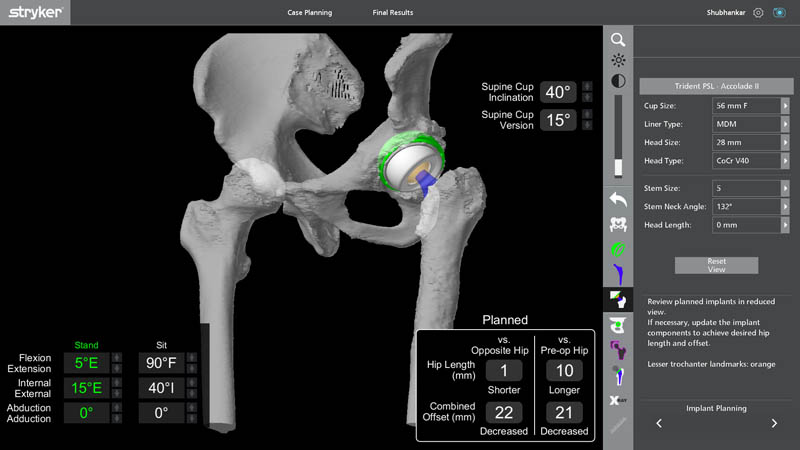 Robotic implant planning for revision hip replacement surgery