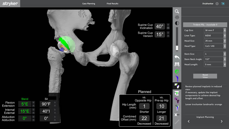 Robotic implant planning for revision hip replacement surgery