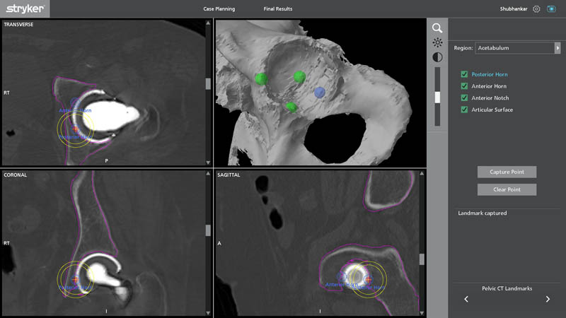 Pelvic CT landmarks for segmentation in robotic revision hip replacement surgery