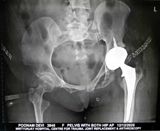 Post Operation for Bikini AMIS in a complex case