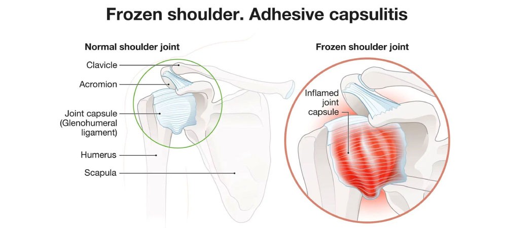 Frozen Shoulder Doctor Meerut